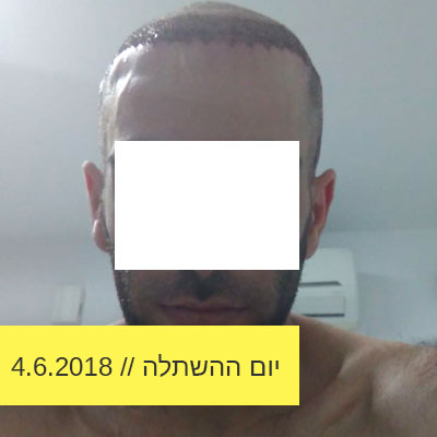 Read more about the article יום ההשתלה הראשון