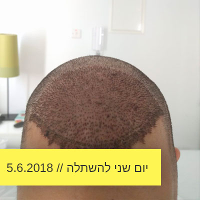 Read more about the article יום ההשתלה השני